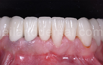 Dental Crown Cases